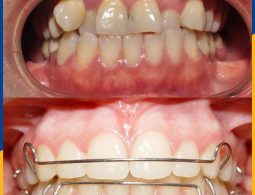 Tình trạng răng trước và sau khi niềng của bạn Quang Huấn