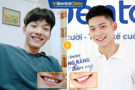 Bạn Quang Huấn Review Niềng Răng Trong Suốt Tại Vidental Clinic