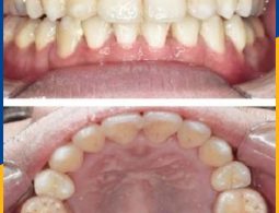 Tình trạng răng của bạn Mai trước và sau khi niềng