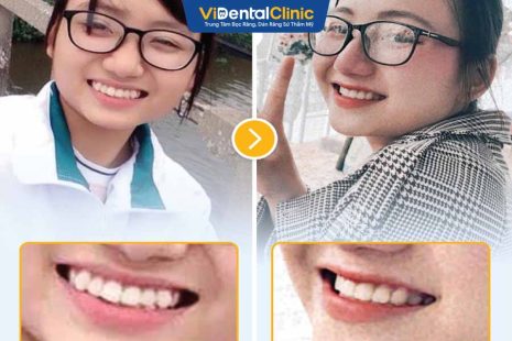 Bạn Thanh Mai Review Niềng Răng Hiệu Quả Cao Tại ViDental Clinic