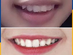 Sự thay đổi rõ rệt của Mai khi niêng răng