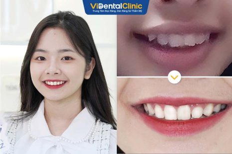 Thảo mai chia sẻ quá trình niềng răng mắc cài kim loại tại trung tâm ViDental Clinic, hành trình lấy lại sự tự tin