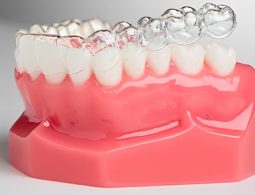 Mỗi phương pháp niềng răng trong suốt có chi phí khác nhau