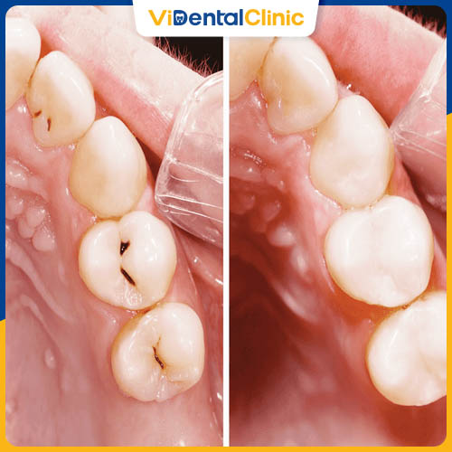 Giá bọc sứ răng sâu bao gồm chi phí xử lý răng sâu và bọc sứ