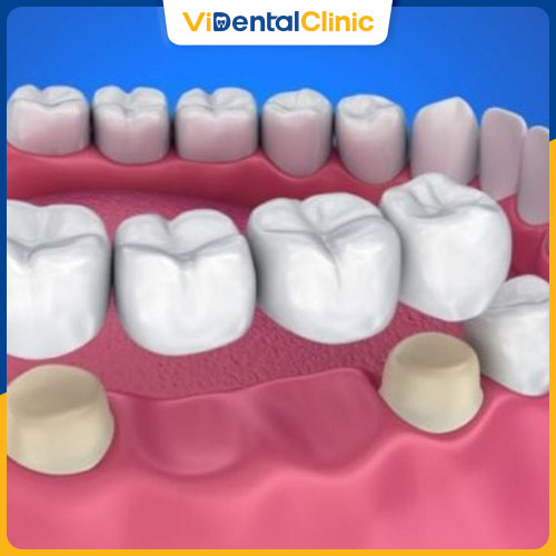 Cầu răng sứ là phương pháp thay thế răng bị mất phổ biến