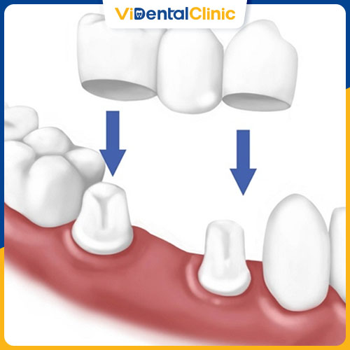 Cầu răng sứ được ưa chuộng bởi có nhiều ưu điểm vượt trội
