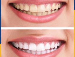 Kết quả sau khi chị Hương tẩy trắng răng tại ViDental Clinic