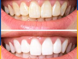 Hình ảnh chị Lan Hương trước và sau khi tẩy trắng răng