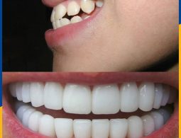 Hình ảnh chị Minh Anh trước và sau khi bọc răng sứ