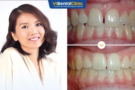 Chị Thu Hằng Review niềng răng Invisalign tại Trung Tâm ViDental Clinic