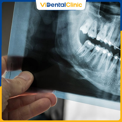 Chụp X-quang răng khôn bao nhiêu tiền được nhiều khách hàng quan tâm