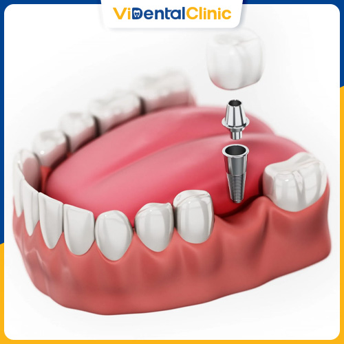 Răng Implant có thể duy trì tuổi thọ lên đến hơn 20 năm