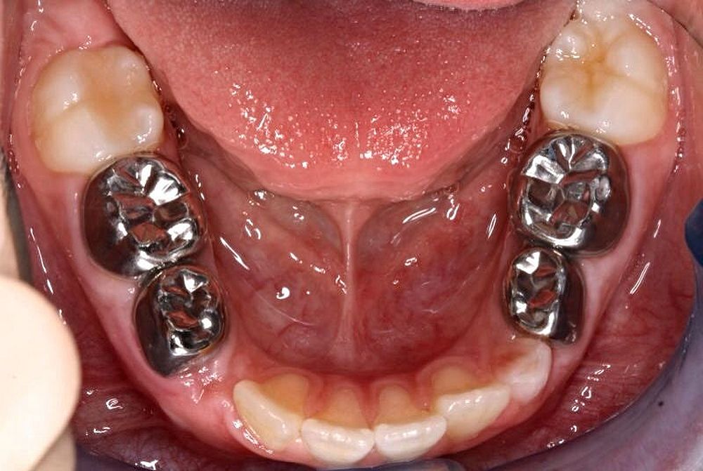 https://viennhakhoathammy.com/wp-content/uploads/2023/12/dental-crowns.jpg