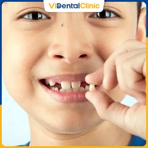 Trẻ từ 6 tuổi bắt đầu thay răng sữa