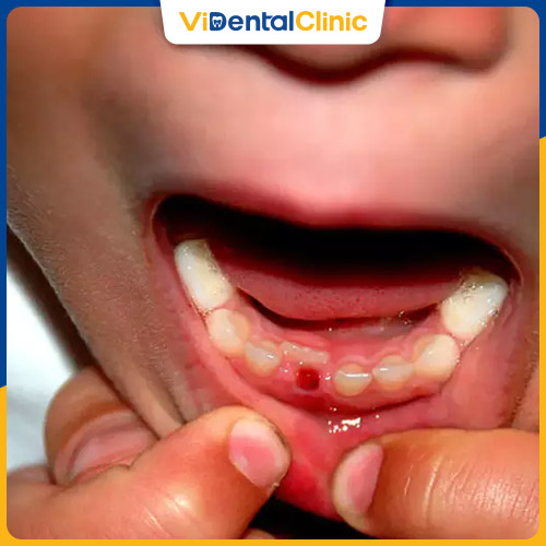 Nhổ răng sữa sớm gây ra nhiều hệ quả nghiêm trọng