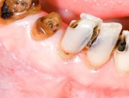 Mắc bệnh lý răng miệng cần chi trả phí điều trị
