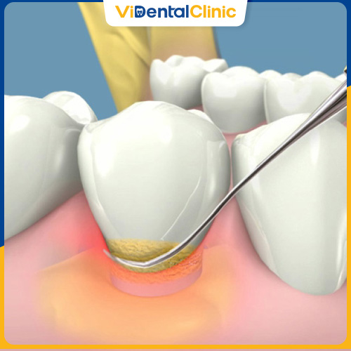 Lấy cao răng từ 3 - 6 tháng/lần hoặc theo chỉ định của bác sĩ