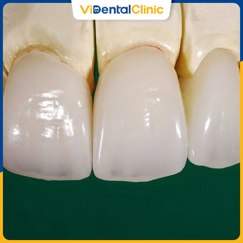 Răng sứ Ceramill có độ bền cao và không gây kích ứng