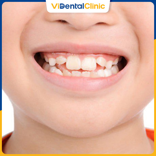Thời gian mọc răng vĩnh viễn ở trẻ dao động từ 1 – 2 tháng