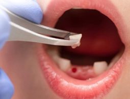 Kỹ thuật nhổ răng ảnh hưởng đến tổng chi phí