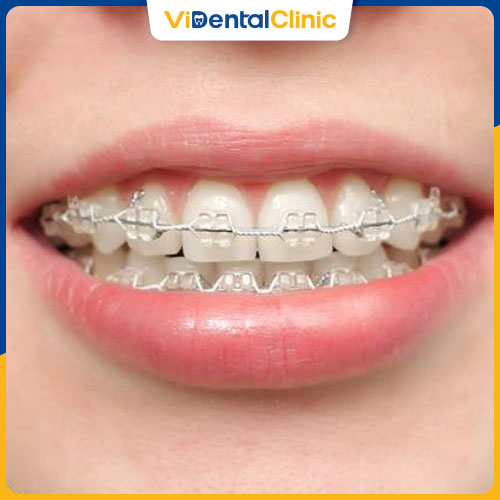 Niềng răng hô giúp cải thiện hiệu quả vấn đề răng miệng