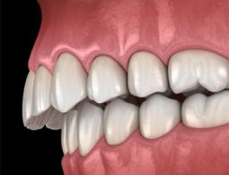 Mức độ lệch lạc của răng