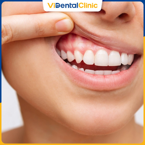 Nướu răng bao bọc xung quanh cổ răng và xương ổ răng