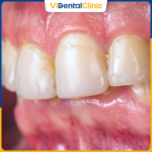 Nướu răng đóng vai trò quan trọng trong khoang miệng