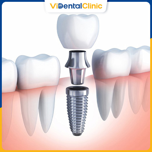 Quy trình trồng răng sứ với Implant phức tạp và lâu hơn