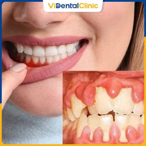 Răng nứt vỡ do mắc bệnh lý răng miệng nhưng không được xử lý