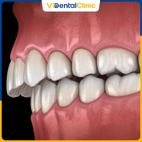 Răng hô nặng có thể do bệnh lý xương hàm