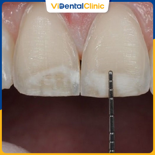 Mài răng hô nhẹ giúp khắc phục tình trạng răng hô nhẹ hiệu quả