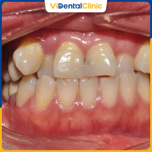 Răng khấp khểnh là tình trạng phổ biến