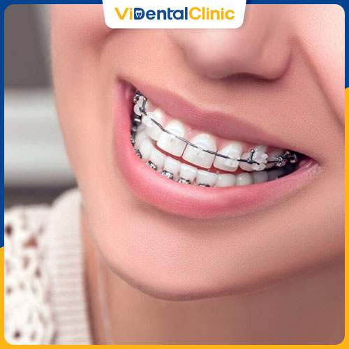 Niềng răng là một trong những phương pháp chỉnh nha hiệu quả