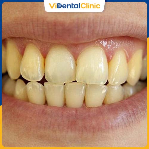 Những người có răng ố vàng có thể bọc răng để cải thiện thẩm mỹ