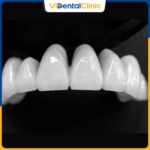 Răng sứ Nacera là loại răng có nguồn gốc từ Đức
