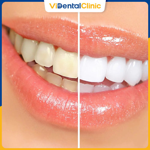 Bọc răng sứ mang đến cho khách hàng hàm răng trắng sáng