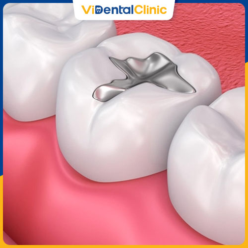 Trám răng xử lý được răng sâu ở nhiều mức độ