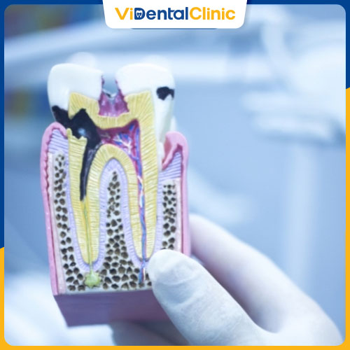 Răng sâu ảnh hưởng xấu tới toàn bộ cấu trúc răng miệng