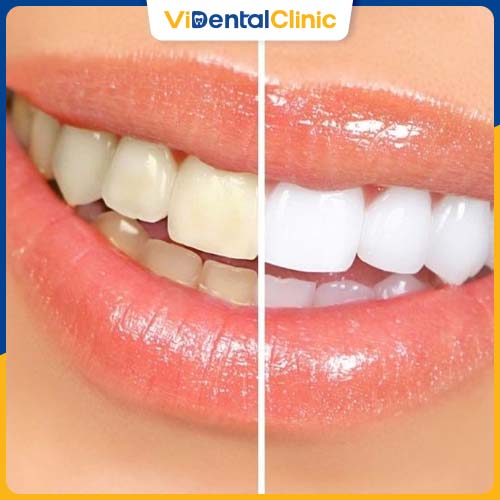Tẩy trắng răng laser hiệu quả cao, giúp răng trắng sáng lên từ 4-5 tông màu