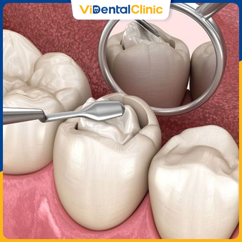 Trám răng giúp khôi phục hình dáng ban đầu của răng