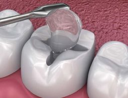 Mỗi vật liệu trám răng khác nhau có chi phí khác nhau