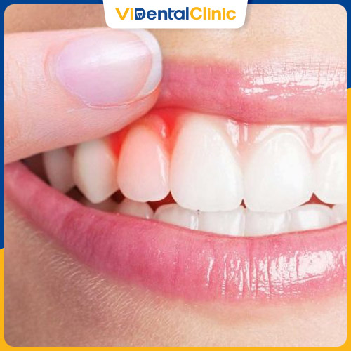 Trám răng lấy tủy giá rẻ có thể gây viêm nha chu