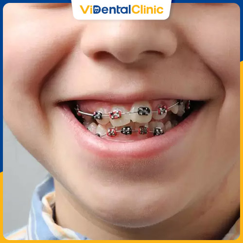 Niềng răng sớm giúp răng vĩnh viễn mọc lên thẳng hàng