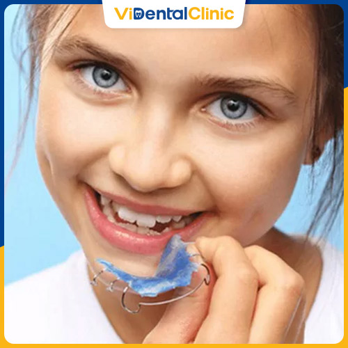 Trẻ từ 6 tuổi có thể niềng răng để tránh sai lệch khớp cắn