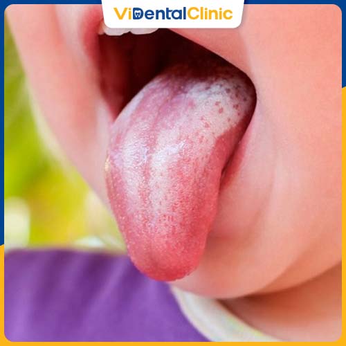Hướng dẫn nhận biết bệnh nấm miệng ở trẻ em