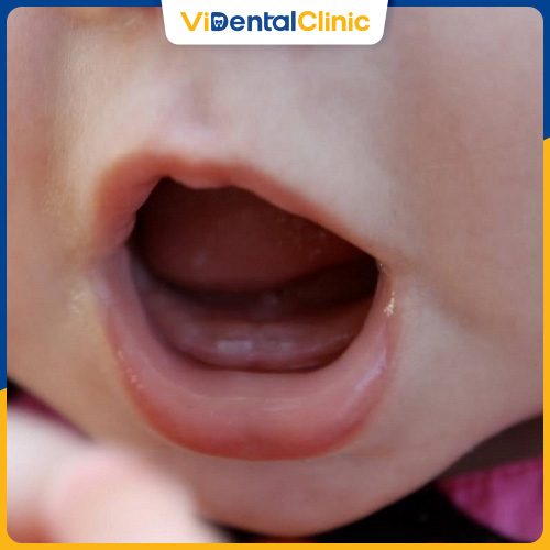 Thiếu hụt dinh dưỡng khiến quá trình mọc răng của trẻ bị chậm