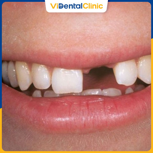 Trồng răng là kỹ thuật nha khoa giúp phục hình răng cửa đã mất