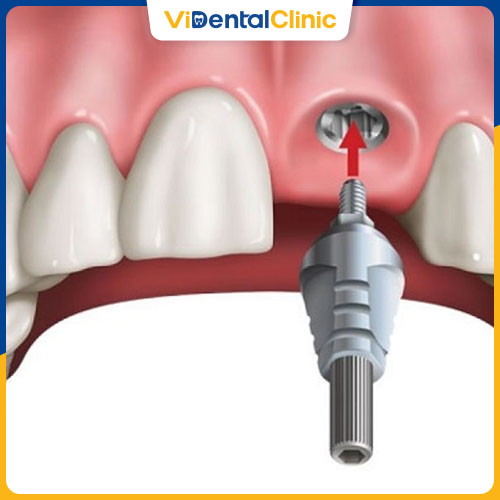 Cấy ghép Implant là cách trồng răng cửa hiệu quả nhất hiện nay