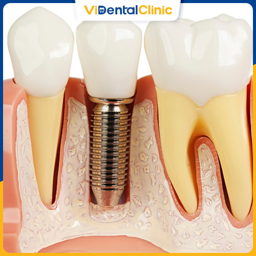 Trồng răng Implant cho hiệu quả cao và tuổi thọ lâu dài nhất